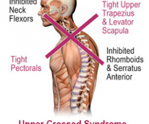 Upper-Crossed Syndrome (UCS)