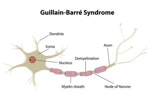 Guillain-Barre Syndrome (or) Infammatory Demyelinating Polyradiculoneuropathy (CIDP)