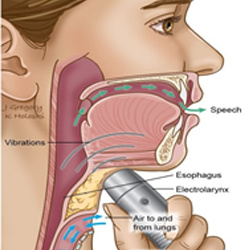 Speech Therapy For Laryngeal Cancer