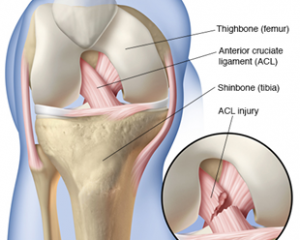 ACL (or) Anterior Cruciate Ligament