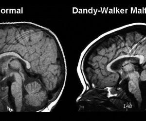 Dandy Walker Syndrome (DWS)