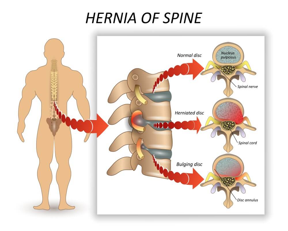 Hernia of Spine