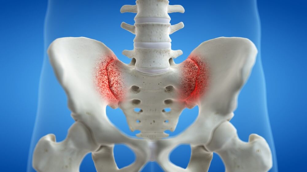 SI Joint Pain, Sacroiliitides, Sacroliliac joint inflammation