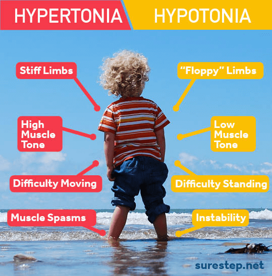 Low tone. Hypertonia Symptoms. Hypotonic (Atonic) cerebral Palsy.