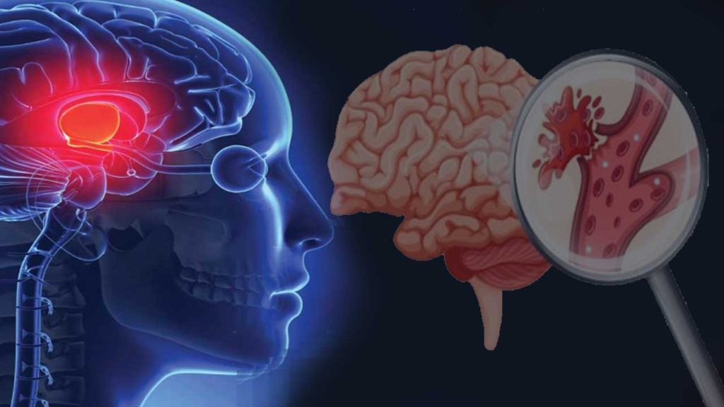 Symptoms of brain stroke