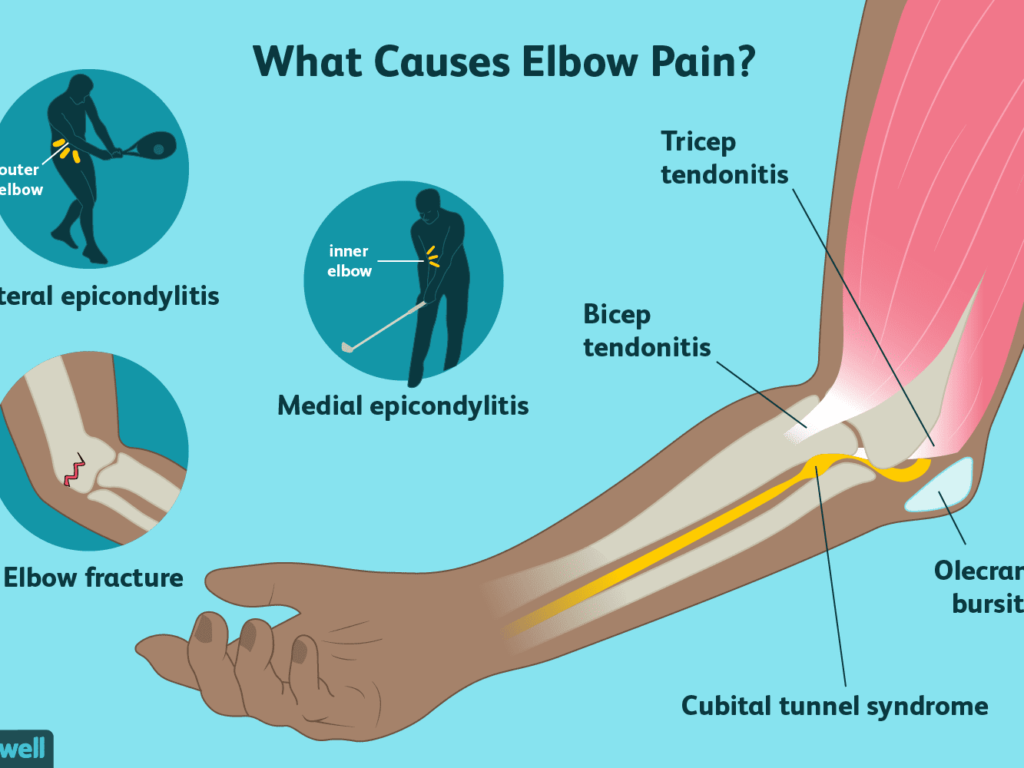 Tennis elbow causes